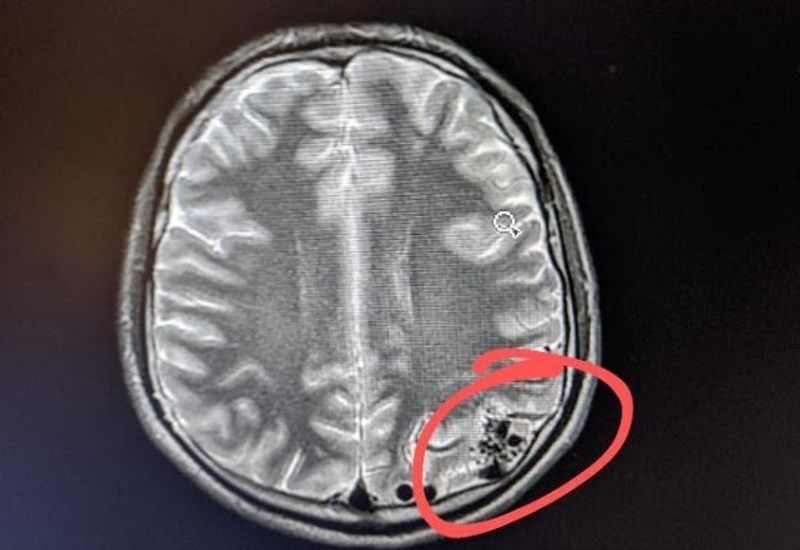 Brain scan with the AVM circled